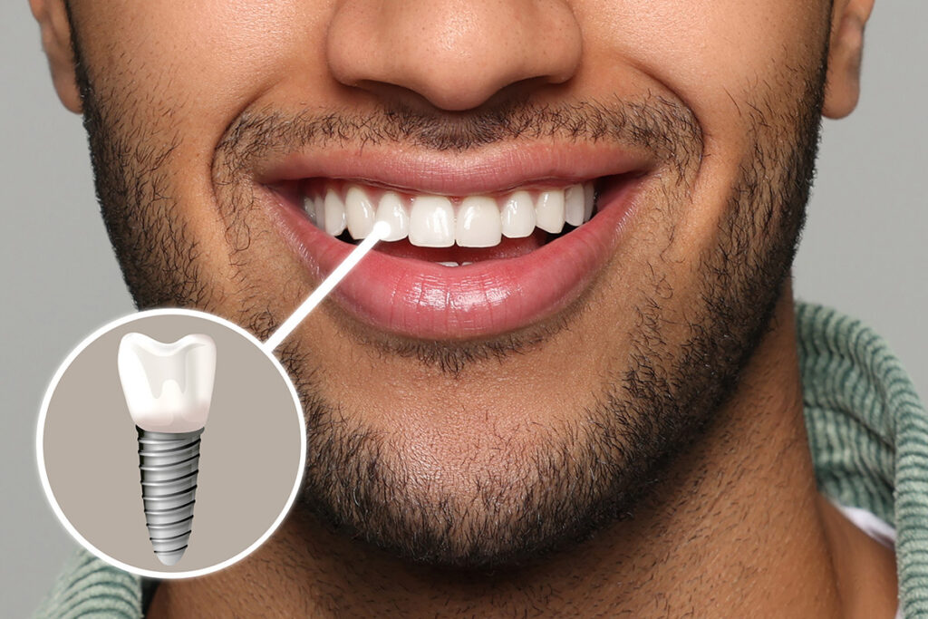 Dental Implant service image at Aspire Dental Spa