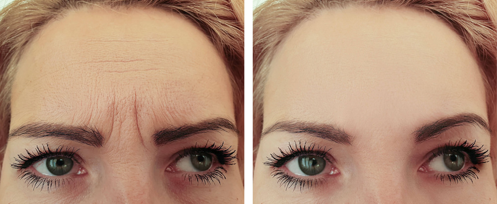 Botox service image at Aspire Dental Spa