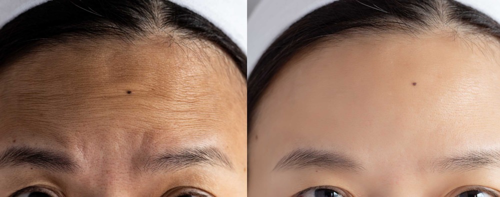 Botox service image at Aspire Dental Spa