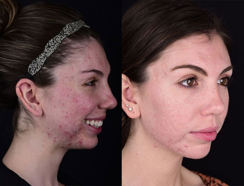 Dermal Fillers service image at Aspire Dental Spa
