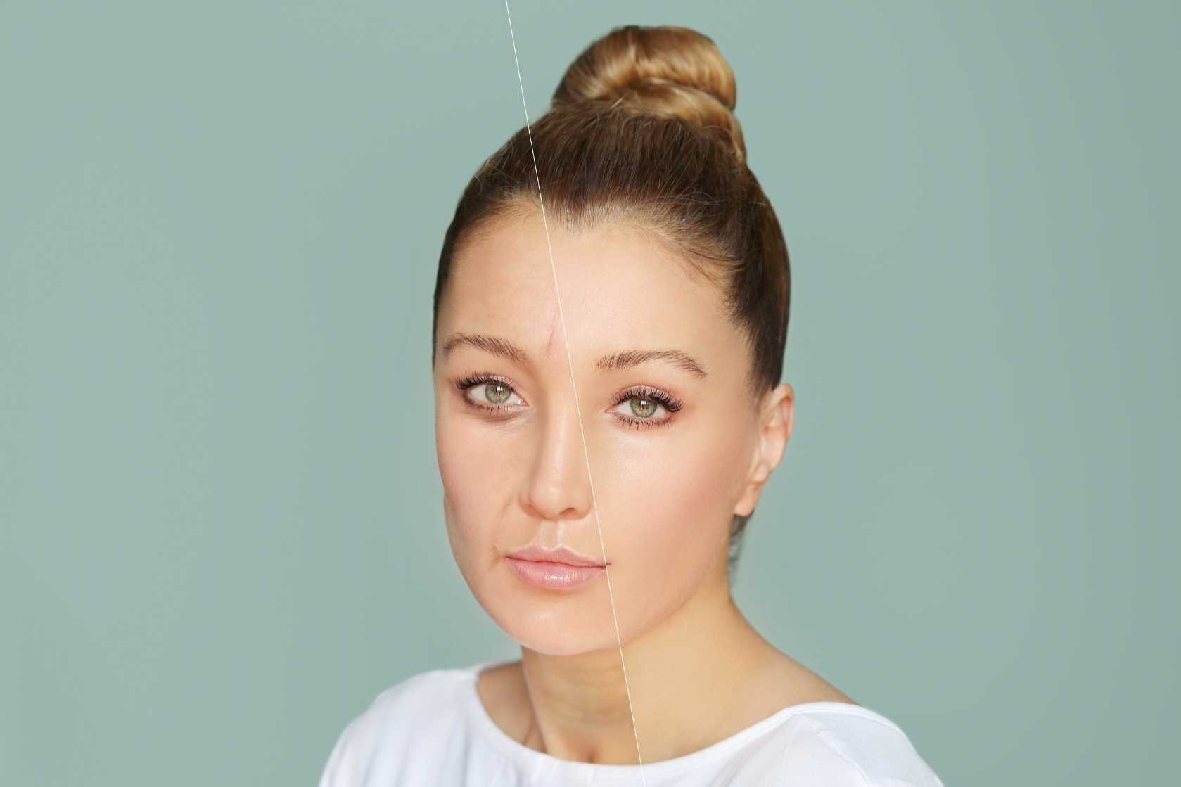 Dermal filler benefits