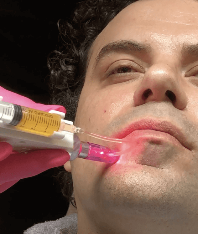 Man microneedling