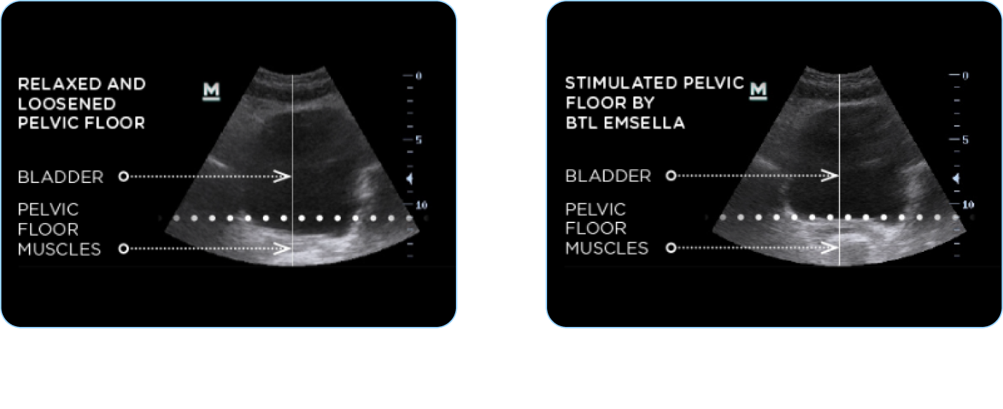 Meet emsella before after