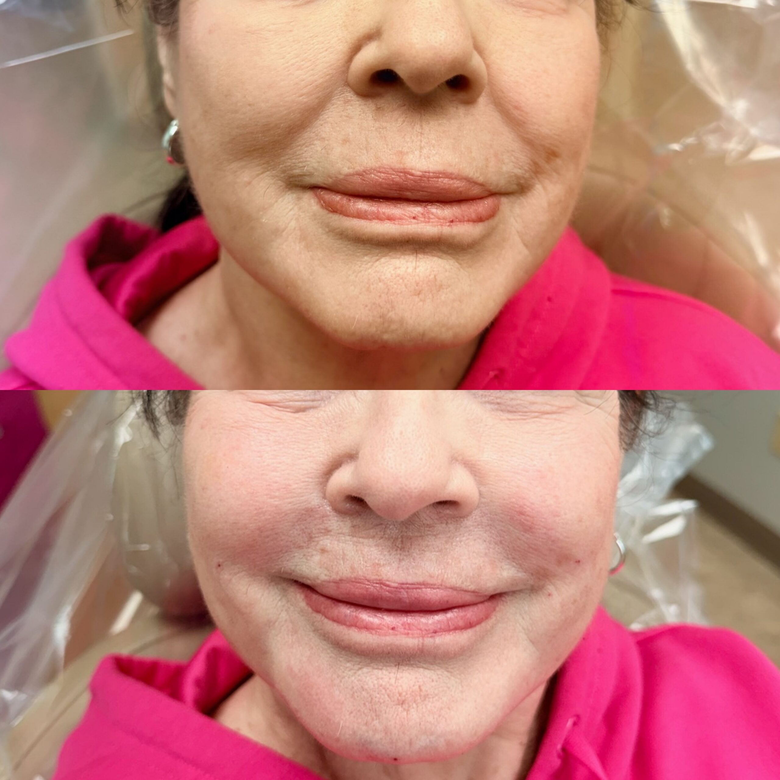 BioFiller Nasolabial Fold B&A