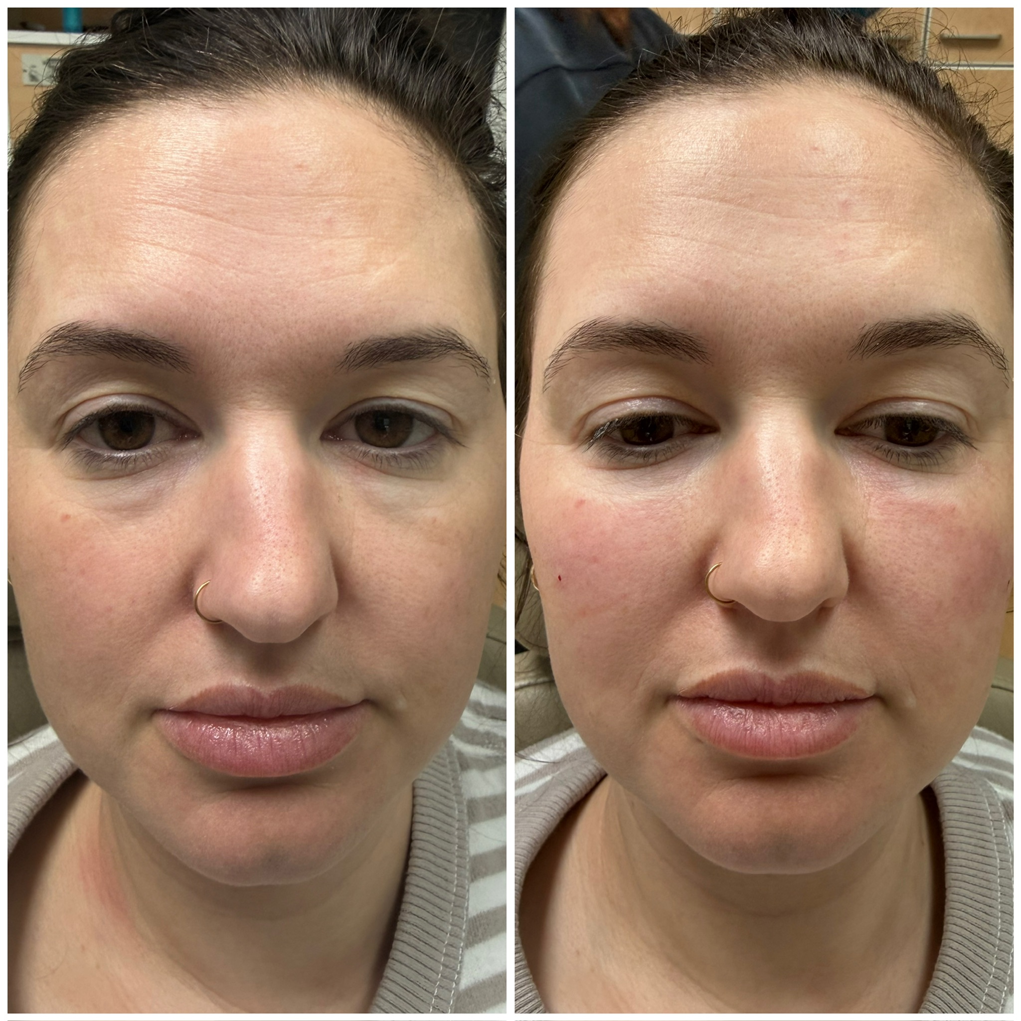 BioFiller-Patient-Results
