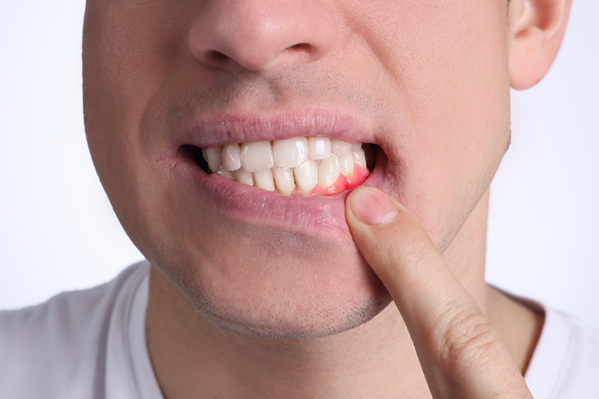 Dental Hygiene in Beachwood, OH: What Bleeding Gums May Be Telling You