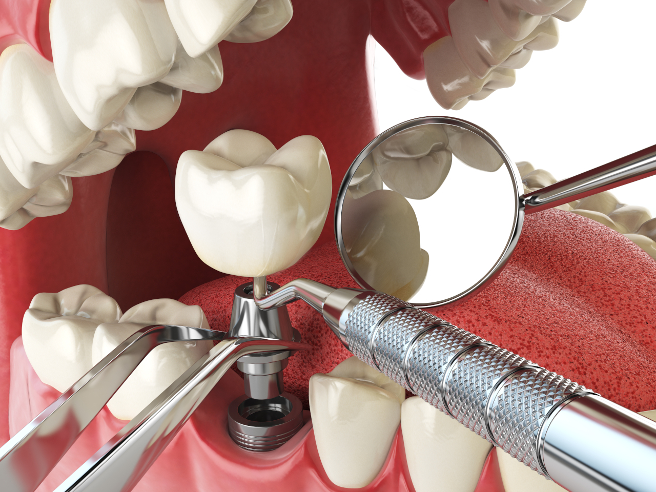 Dental Implants in Beachwood, OH: What to Expect Before, During, and After Treatment